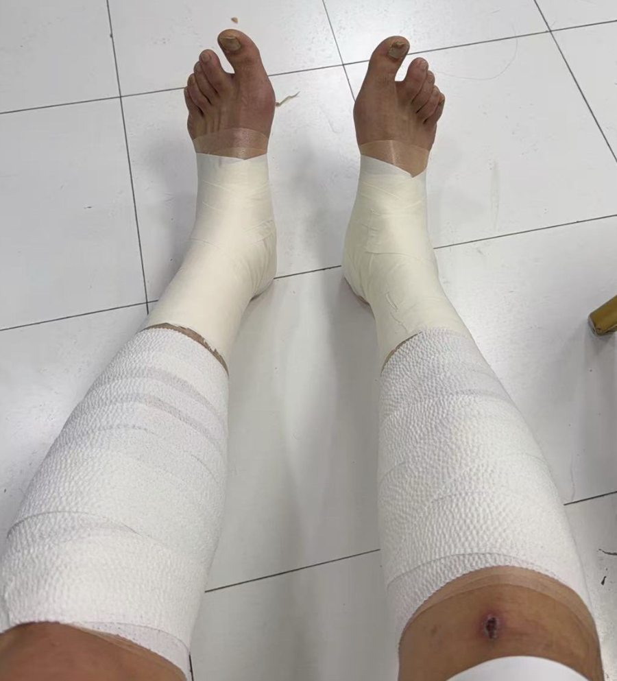 开云官网-胜山西谁注意翟晓川赛后伤势？双腿拉伤绑满绷带，看着都残忍！